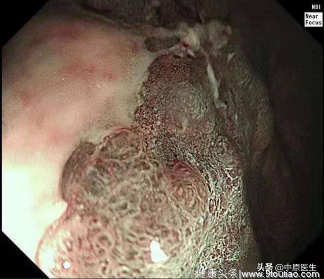 必须活检的胃溃疡：以为是胃溃疡，专家用另一方法放大发现是胃癌
