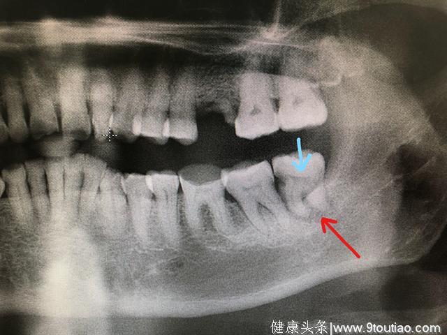 牙医的话您还是听听吧。