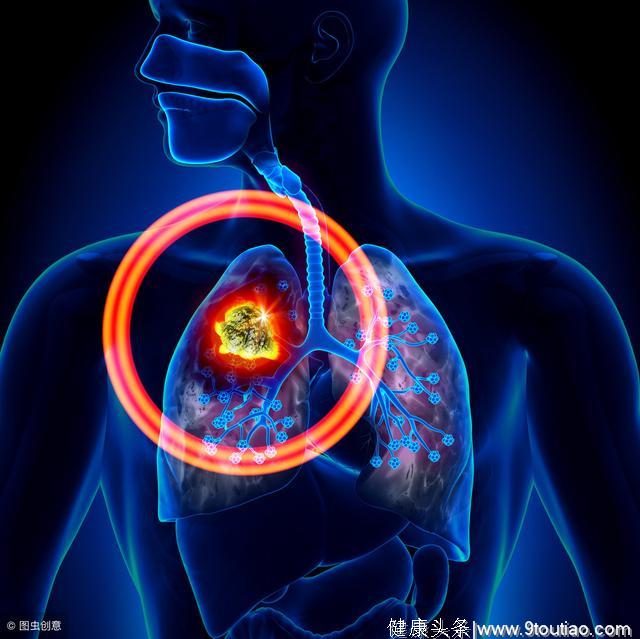 “肺癌”早期，这几个症状可能会提醒你