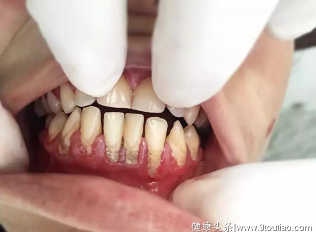 世界上最烂的牙齿能烂到什么程度