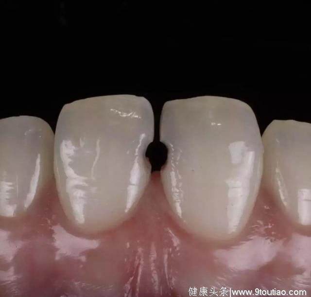 世界上最烂的牙齿能烂到什么程度