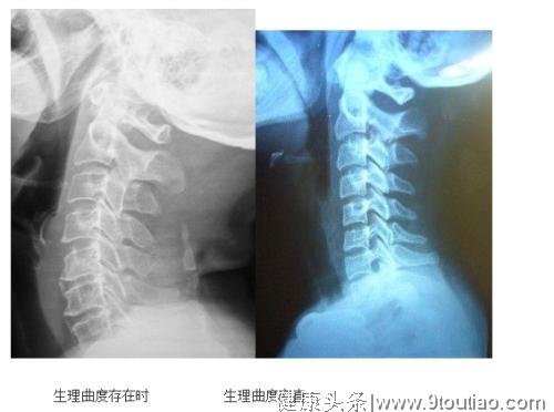 颈椎曲度变直了 纯手法治疗效果好