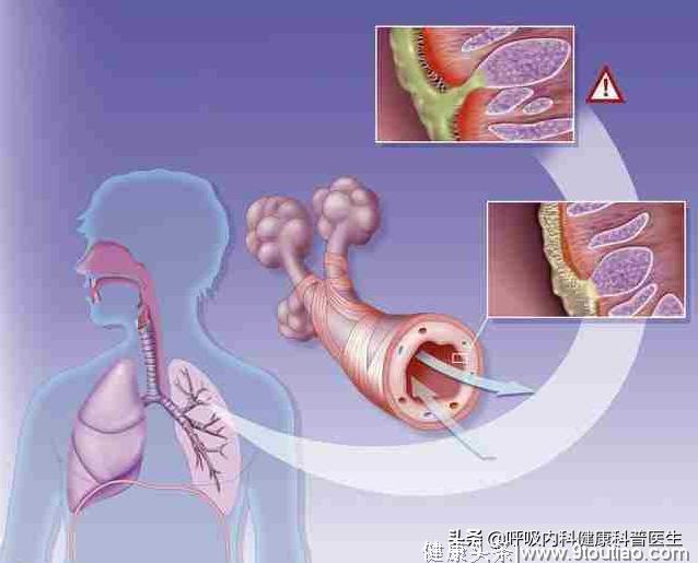 支气管炎 哮喘 肺气肿 慢阻肺的发展?慢阻肺简单排痰训练要知道！