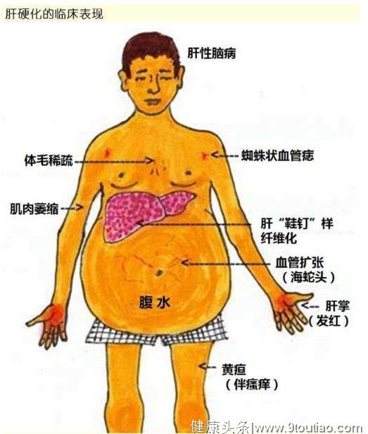 肝硬化多半是“拖”出来的？医生：一旦出现3个症状，尽早就医！