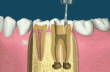 乳牙的根管治疗