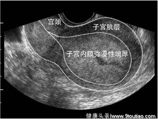 子宫内膜增厚怎么办？