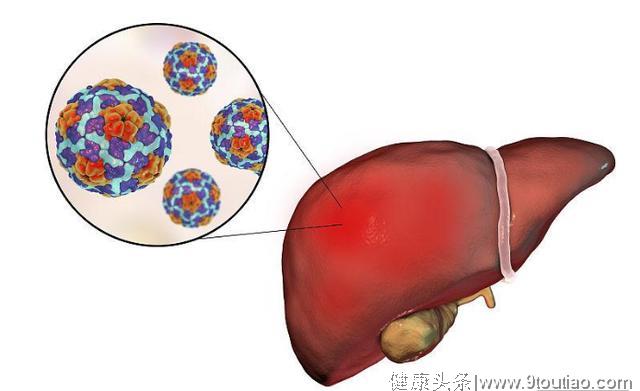 36岁男子，因"肝硬化"并发症离世，医生警示：这1物，一定要戒