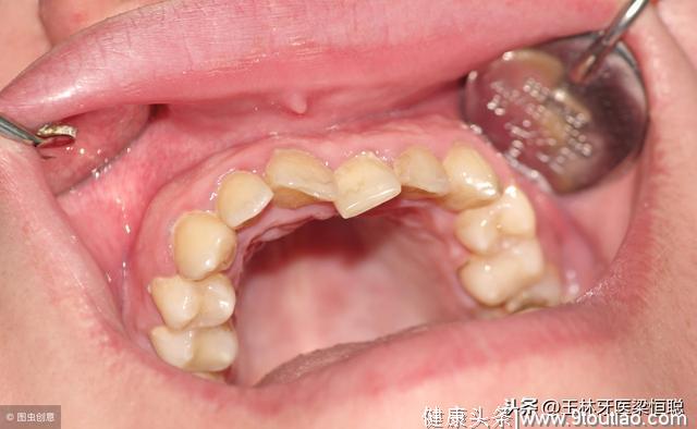 牙齿矫正的常见5大问题，解答一些矫正热门问题