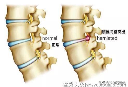 预防腰椎间盘突出？这套臀腰放松的瑜伽序列一定要常练！