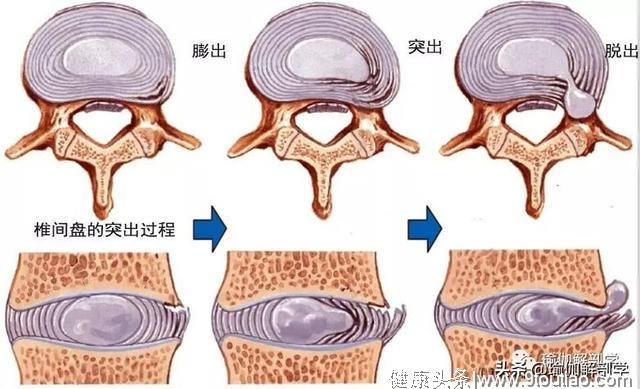 预防腰椎间盘突出？这套臀腰放松的瑜伽序列一定要常练！