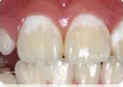 你的门牙上有白斑吗？常见牙齿变色的原因浅谈