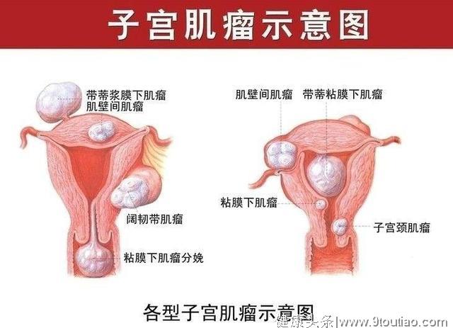 子宫肌瘤大多不会影响怀孕，除了这几种情况