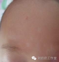 起白斑就 是白癜风？这几种皮肤病也可能让宝宝的皮肤变白！