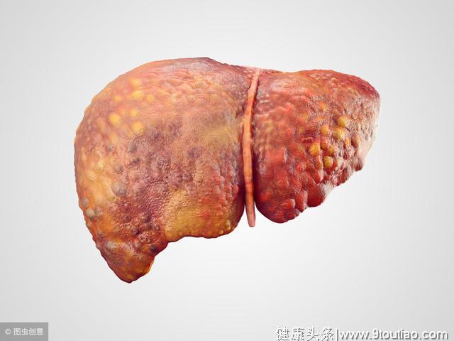 肝硬化早期 身体可能有3个变化 常吃2物 将肝脏变软