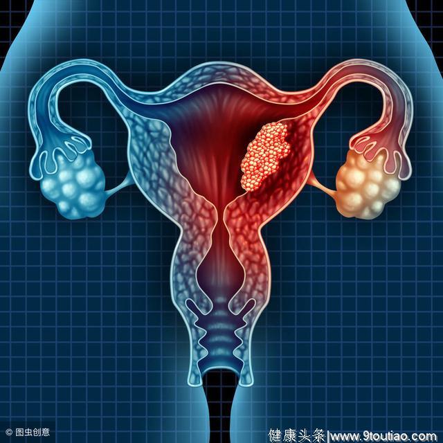 女人经期若出现“异象”，可能是宫颈癌来“捣乱”了
