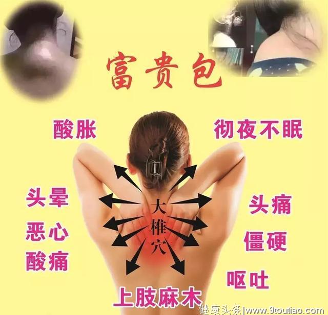 富贵包 我们的颈椎杀手之一 怎么治疗更好