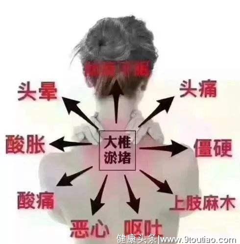 富贵包 我们的颈椎杀手之一 怎么治疗更好