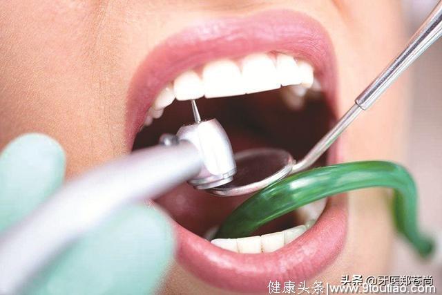 有两颗蛀牙医生说要做根管治疗，这种会不会对牙齿有什么副作用？