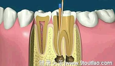 有两颗蛀牙医生说要做根管治疗，这种会不会对牙齿有什么副作用？