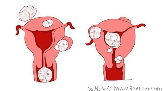 妇科医生：子宫肌瘤病人的饮食禁忌注意事项有哪些？