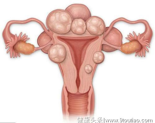 妇科医生：子宫肌瘤病人的饮食禁忌注意事项有哪些？