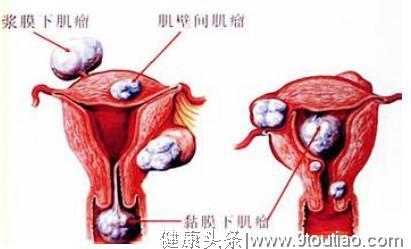 妇科医生：子宫肌瘤病人的饮食禁忌注意事项有哪些？