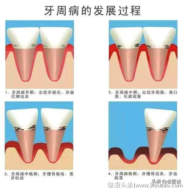 牙膏选不对，毁了一口牙！牙医最怕的3种牙膏，你还在用吗？