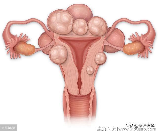 医生直言：长了子宫肌瘤的女人，很多会有这2个表现
