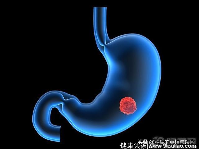 日本胃癌治愈率远超中国，根源在哪？可总结为6个字