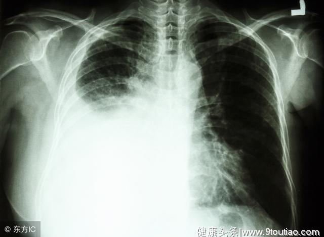 肺癌大多是“熏”出来的，专家：做好这4件事，肺会慢慢变好