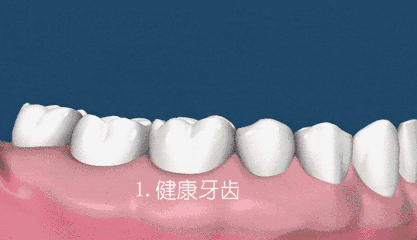 【口腔315】洗牙会破坏牙釉质？牙缝会变大？这些说法是真是假？