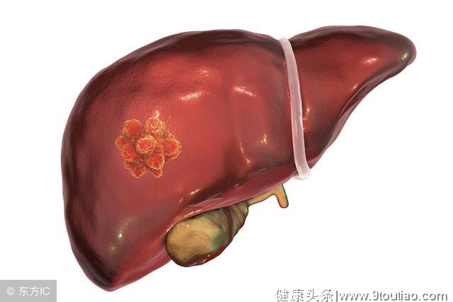 肝癌无症状吗？医生：当身体透露这4个信号时，肝已经病得不轻