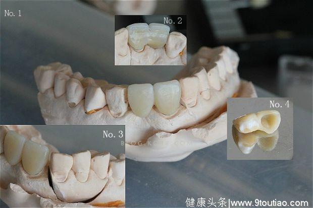 一招教你如何正确选择牙齿修复方式！
