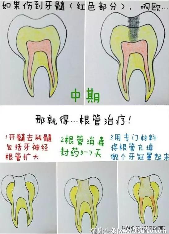 牙齿有蛀牙补个牙齿需要多少钱？到这程度牙齿就要脱落了！