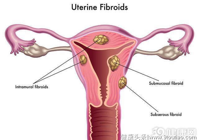 出现这四点要当心，可能是子宫肌瘤找上你！