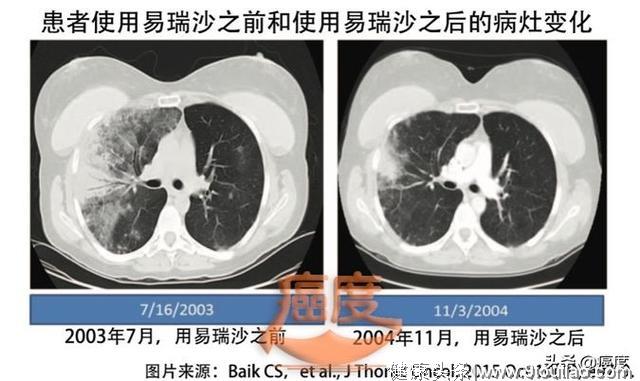 四次复发，六变治疗方案，存活20年的抗癌奇迹！