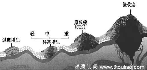 48岁女子体检做了这个检查查出早期肺癌！