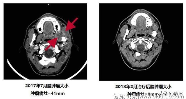 《细胞》重磅：新药有望大幅度提高PD-1有效率！