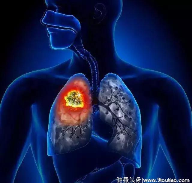 肺癌一经发现基本都是中晚期，高危人群体检要增加这个项目！