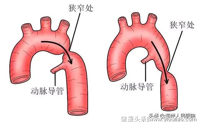 知否？知否？血压高并非因为高血压