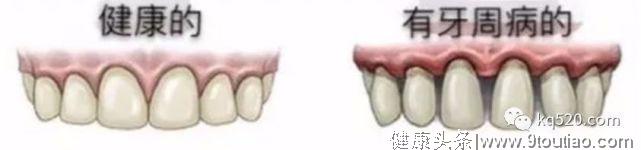 牙龈萎缩并不是口腔疾病的一种！