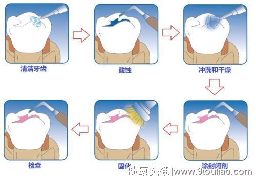 儿童几岁做窝沟封闭比较好？答案在这里