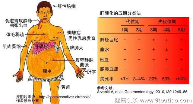 58岁男子腹痛入院，一查肝硬化晚期，医生警示：这2件事害了他！