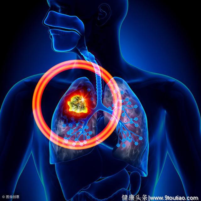 肺癌病患的4个饮食问题