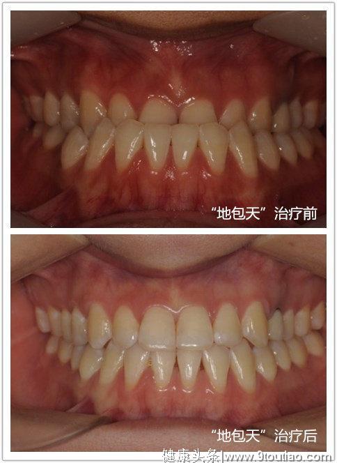 牙齿矫正：告别"地包天"的专属武器