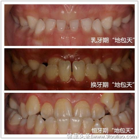 牙齿矫正：告别"地包天"的专属武器