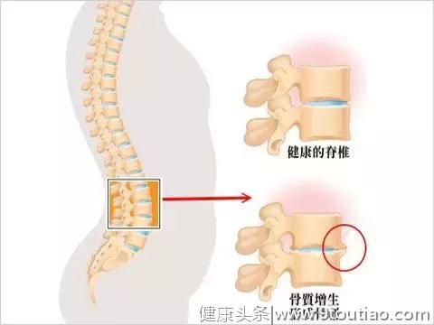 腰椎间盘突出症就是从椎间盘退变、发展变化来的