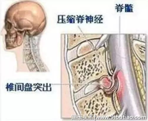 腰椎间盘突出症就是从椎间盘退变、发展变化来的