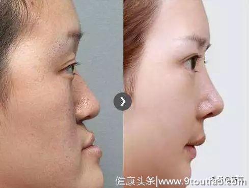 终于找到刘亦菲鼻子如此完美的秘密！鼻炎脸才是毁容于无形啊！