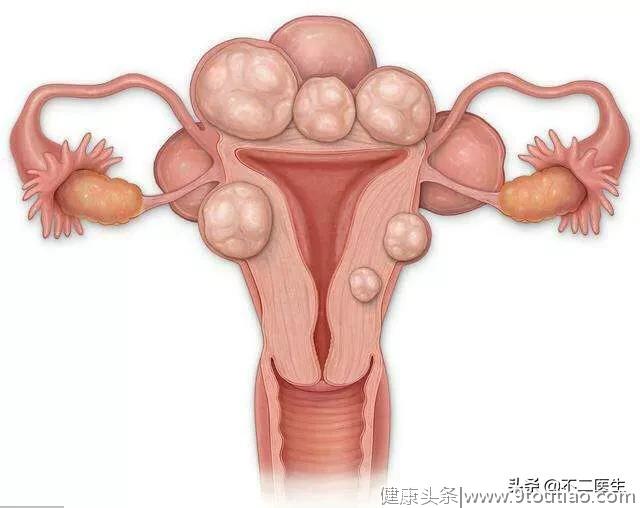 发现子宫肌瘤怎么办？